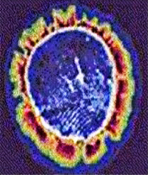 Kirlian Before and After Reiki 